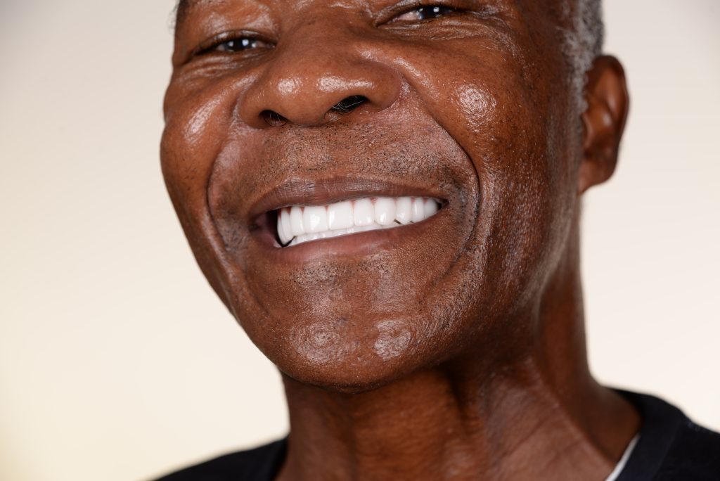 full mouth dental implants turkey happy patient showing smile