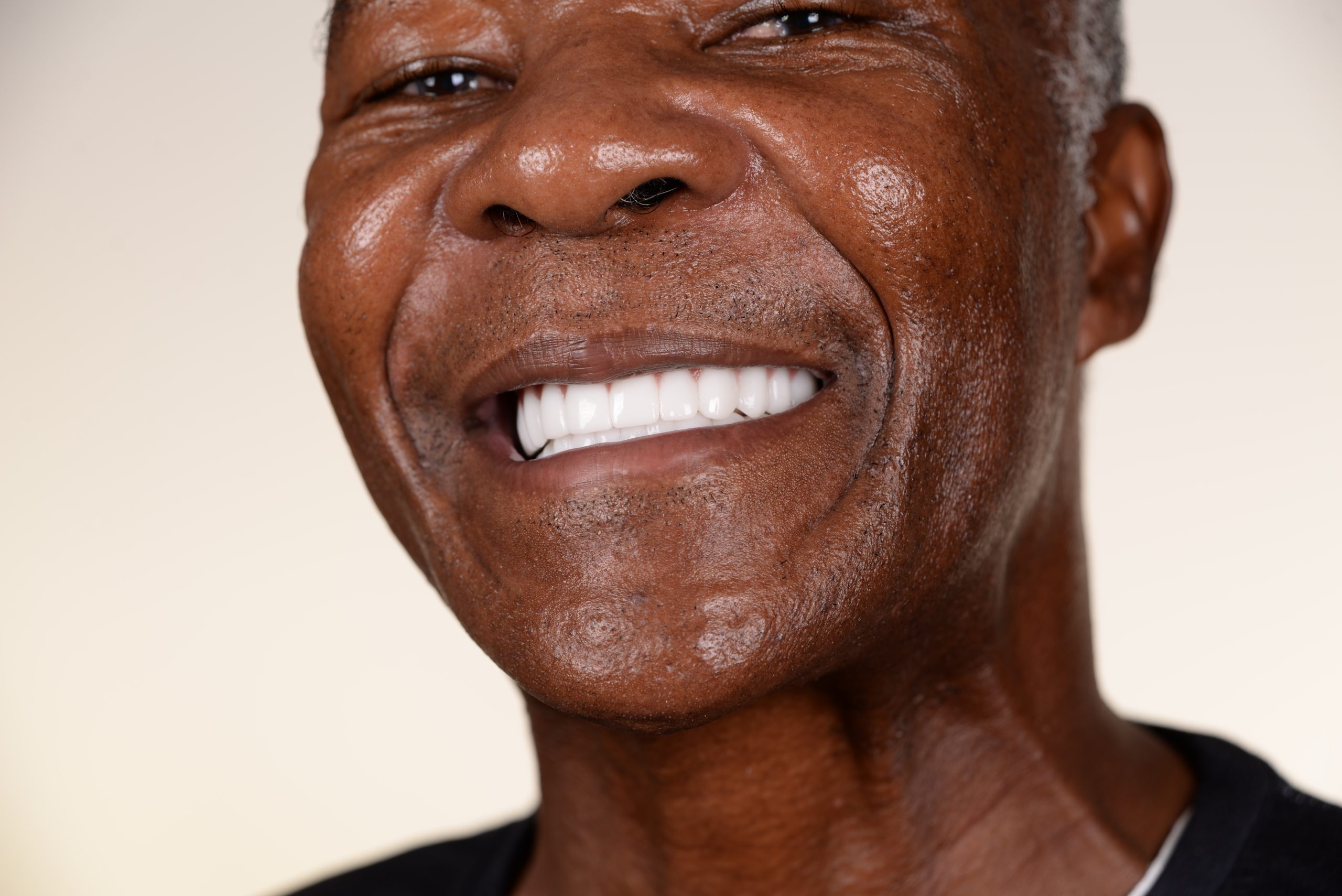 full mouth dental implants turkey happy patient showing smile