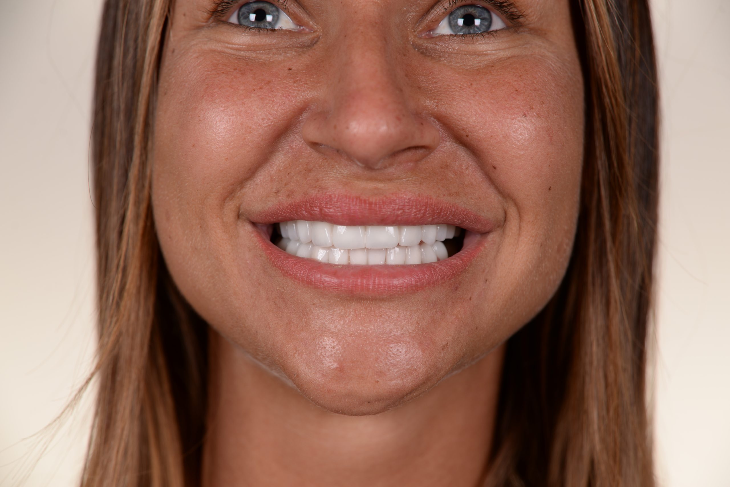 full mouth reconstruction turkey patient showing smile to camera