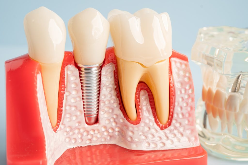 Full Mouth Dental Implants Turkey: Affordable Package Deals for Your Smile Restoration