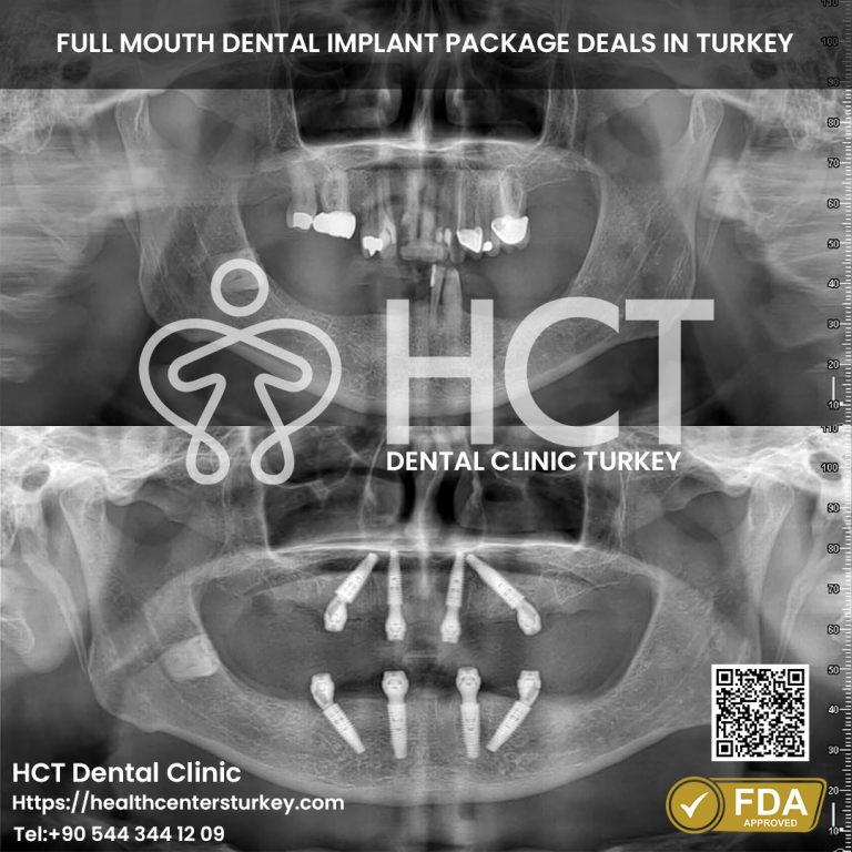 Full-mouth All-on-4 dental implants before and after in Turkey