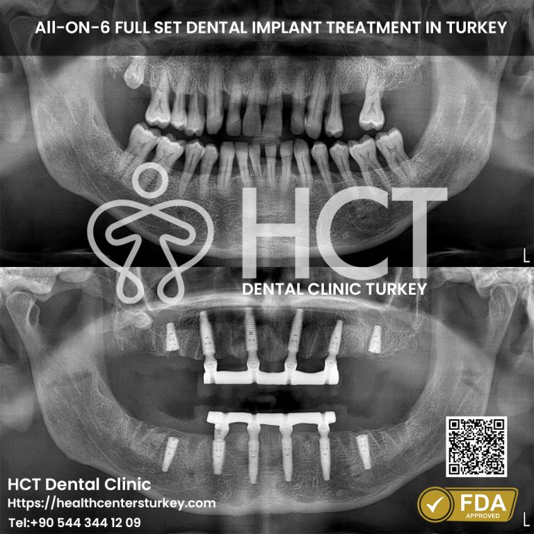 Upper jaw All-on-6 dental implants before and after in Turkey