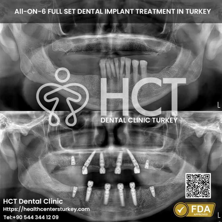 All-on-6 dental implants before and after results in Turkey