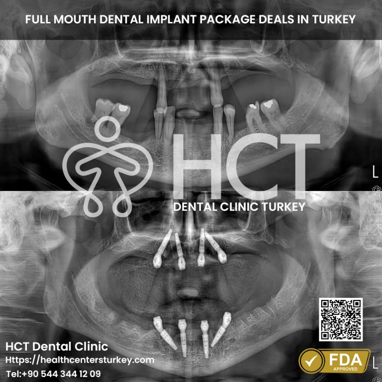 Upper jaw All-on-4 dental implants before and after in Turkey