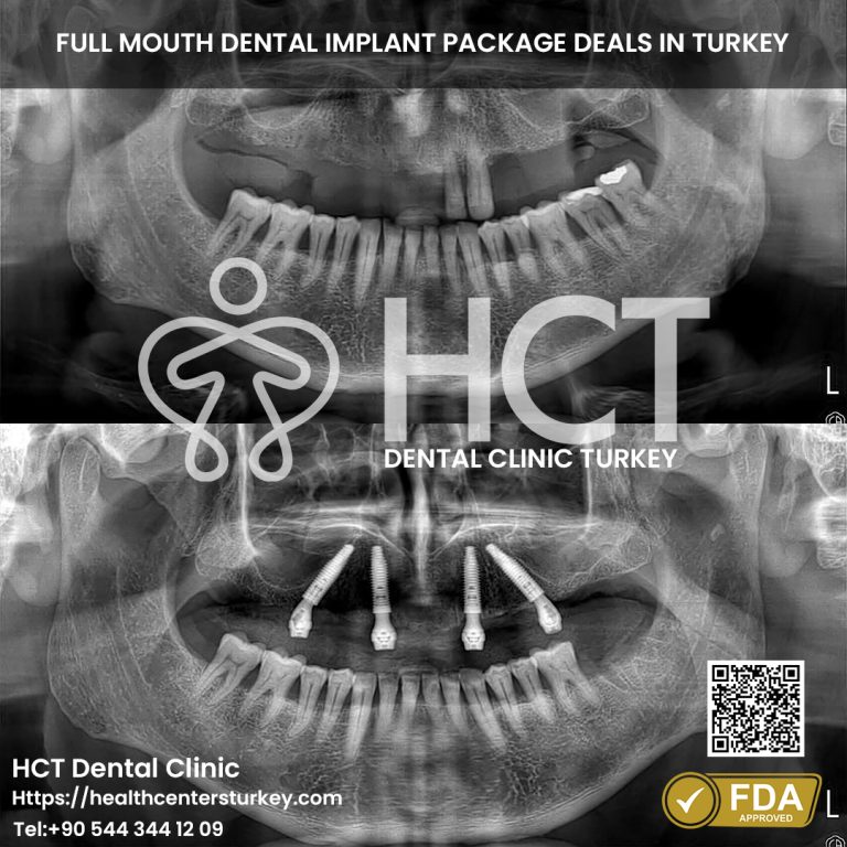 All-on-4 dental implants before and after results in Turkey