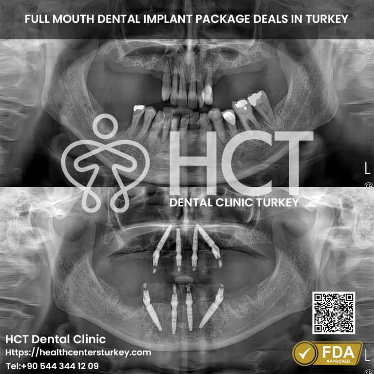 Lower jaw All-on-4 dental implants before and after in Turkey
