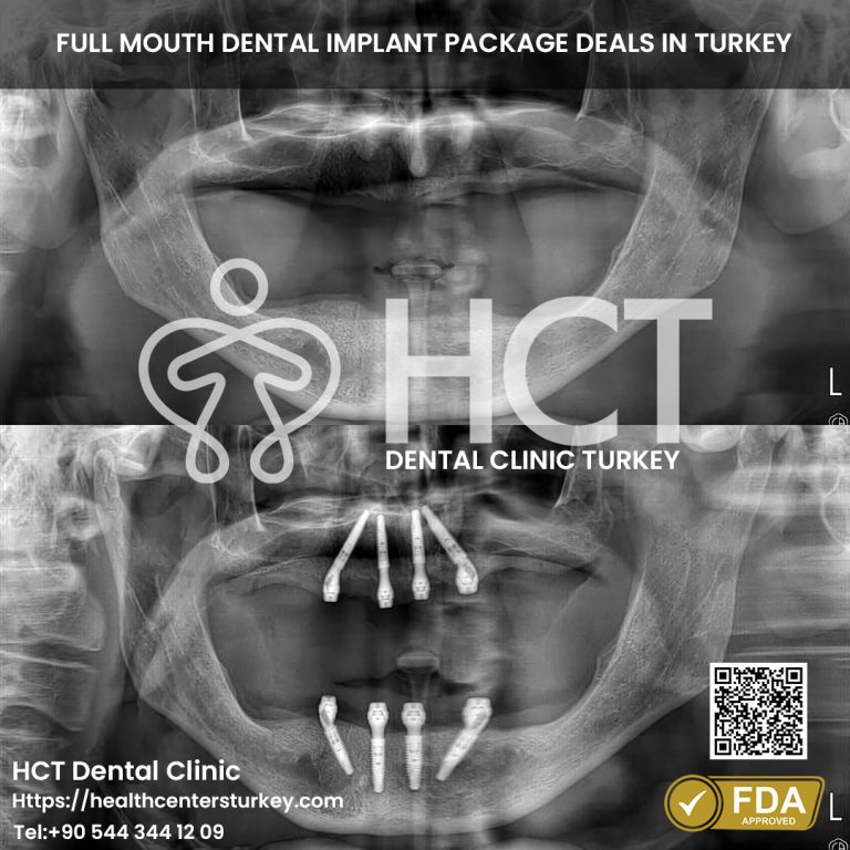 Advanced All-on-4 dental implant treatment before and after in Turkey