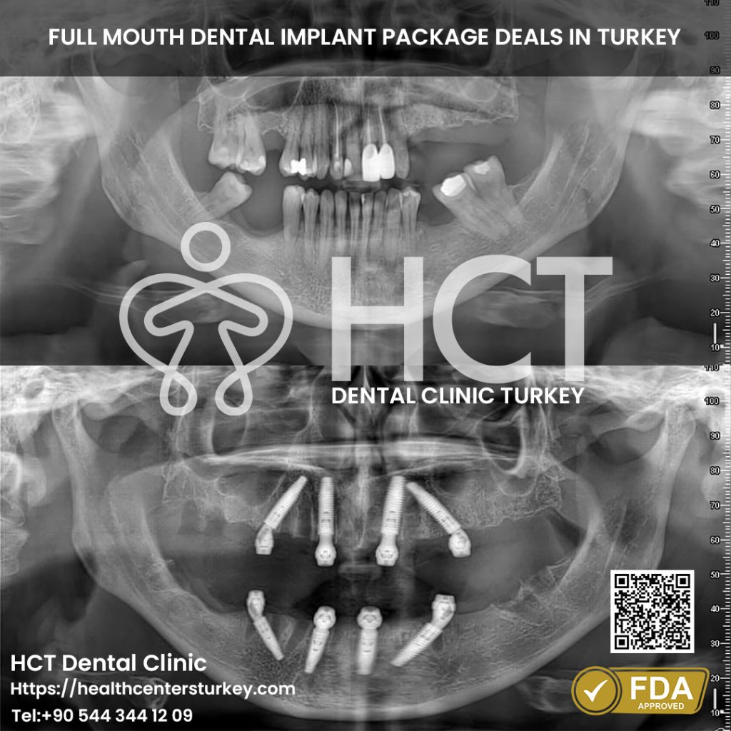 All-on-4 implants before and after X-ray of full-mouth restoration in Turkey