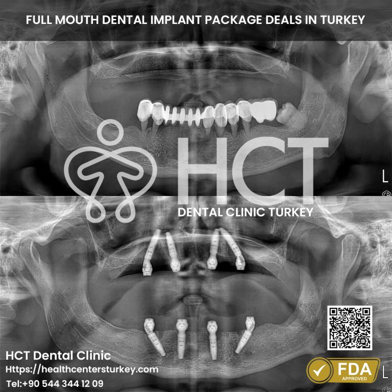 All-on-4 dental implant X-ray showing before and after lower jaw restoration in Turkey