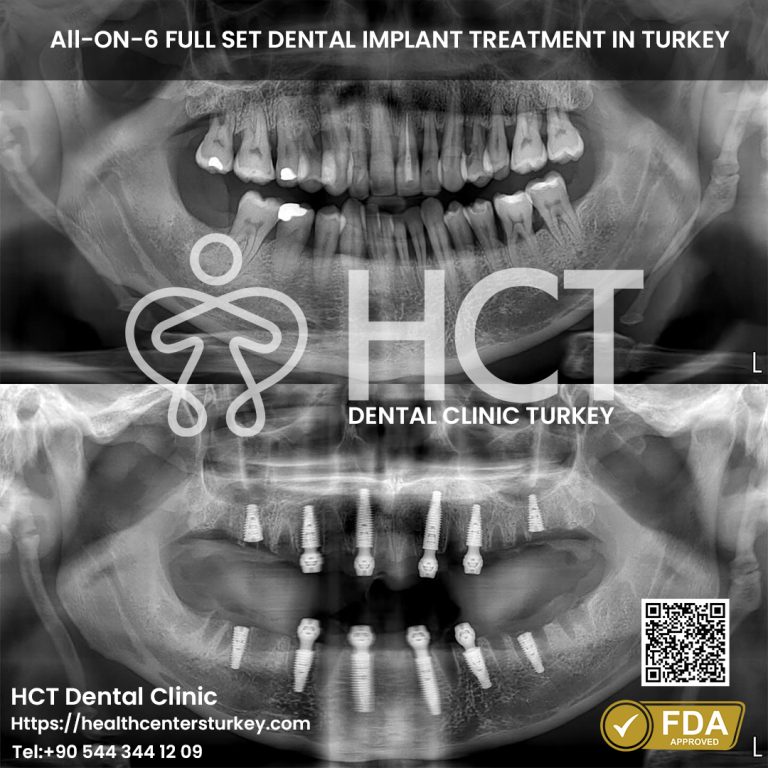 Full-mouth All-on-6 dental implants before and after in Turkey