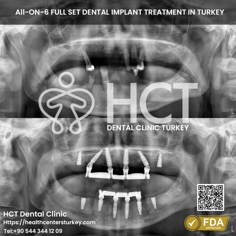 Lower jaw All-on-6 dental implants before and after in Turkey