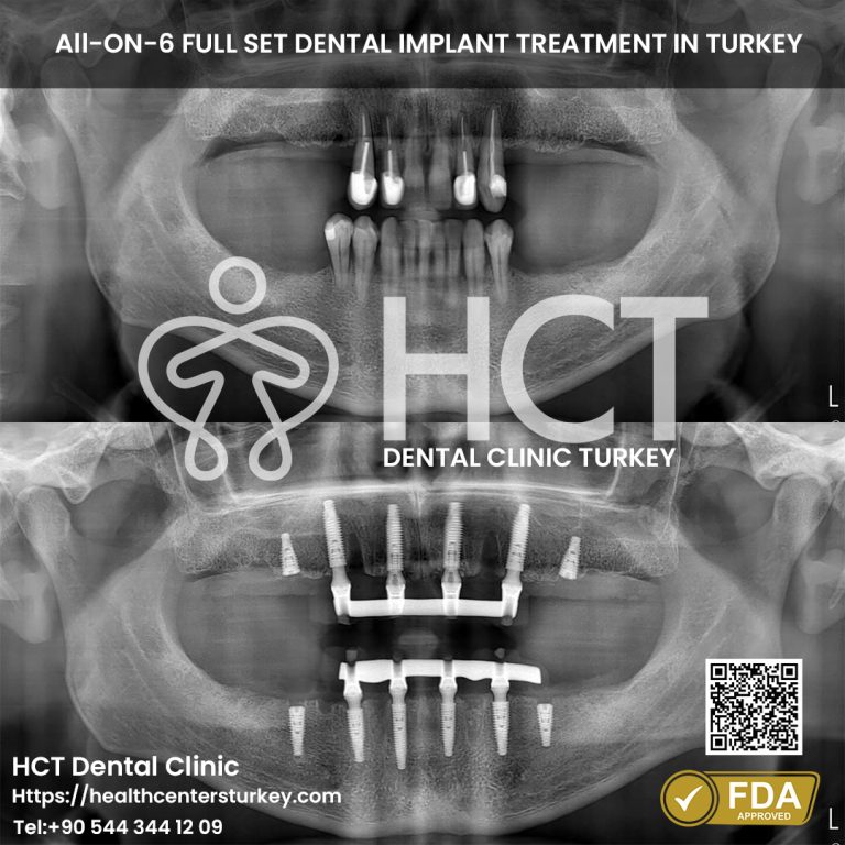 Advanced All-on-6 dental implant treatment before and after in Turkey