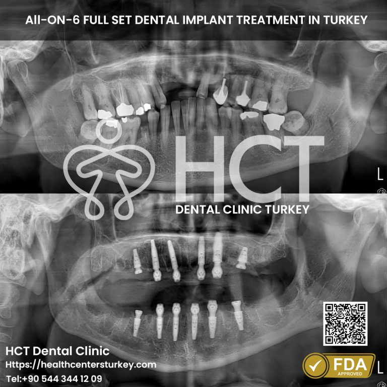 All-on-6 dental implant X-ray showing before and after upper jaw restoration in Turkey