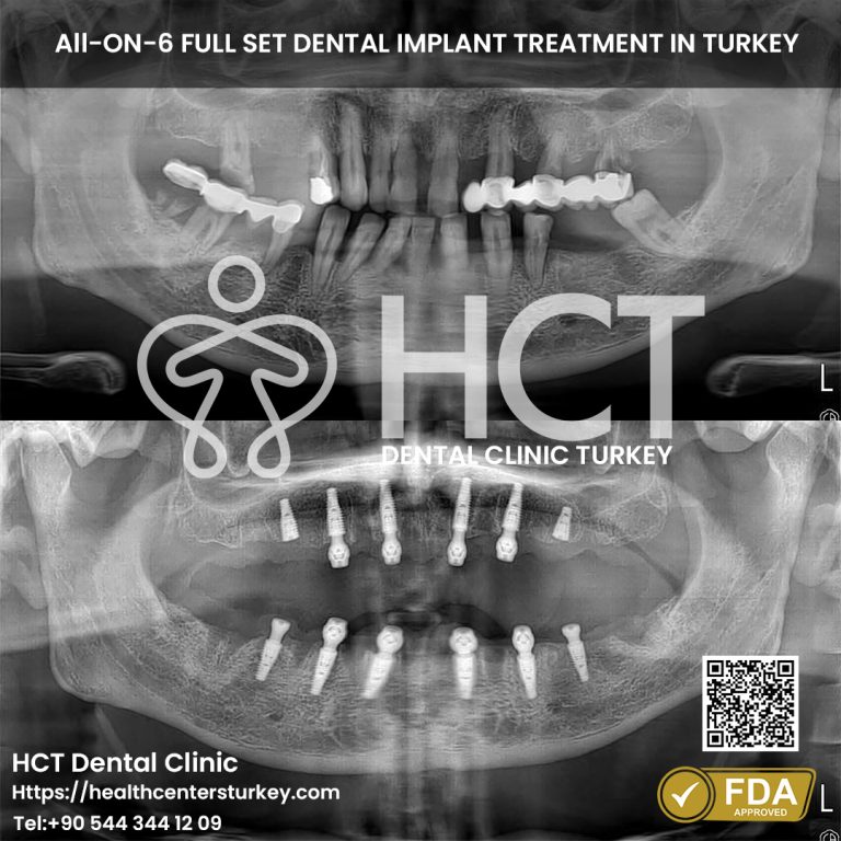 All-on-6 dental implants for upper and lower jaw restoration in Turkey
